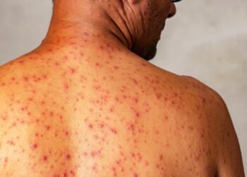monkeypox